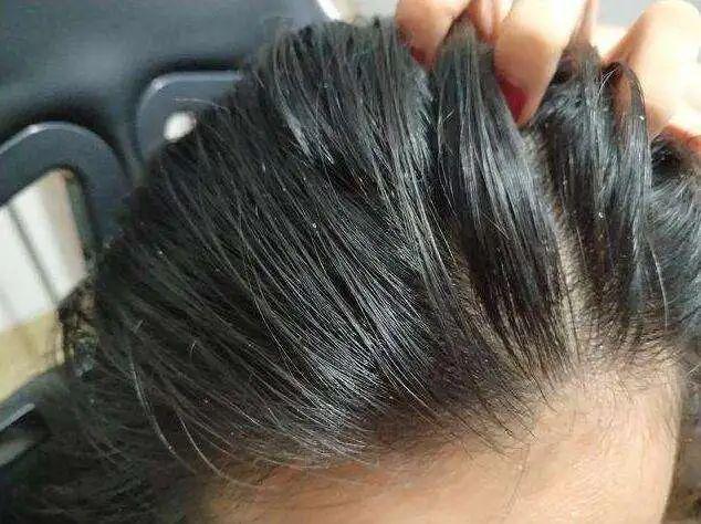 头屑多？头发油？澳洲Pote植酵舒缓专利控油去屑洗发水系列爆卖10w+！