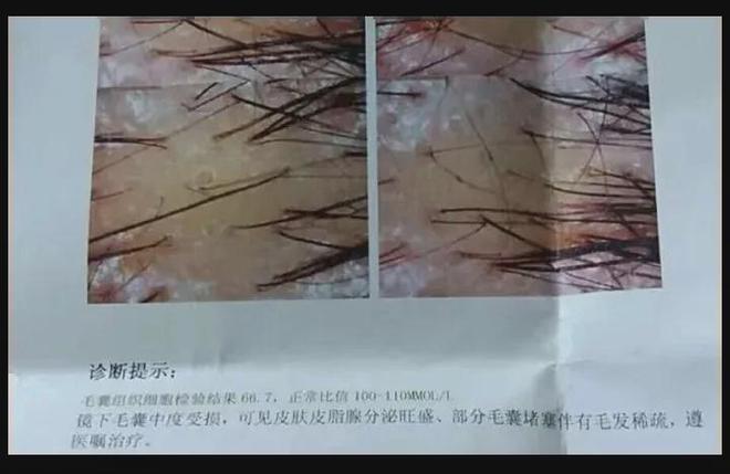 头屑多？头发油？澳洲Pote植酵舒缓专利控油去屑洗发水系列爆卖10w+！(图4)